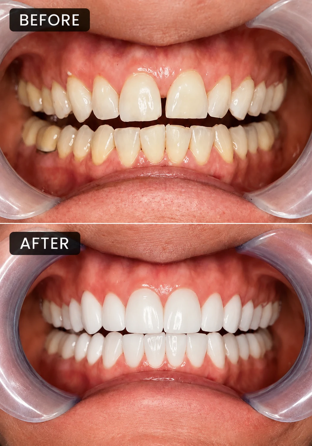 Before-and-after close-up of the upper and lower front teeth, with the before image above the after image